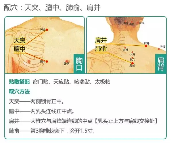体质穴位贴治疗肺部疾病 主要穴位:天突,肺俞,膻中,肩井,内关,外关